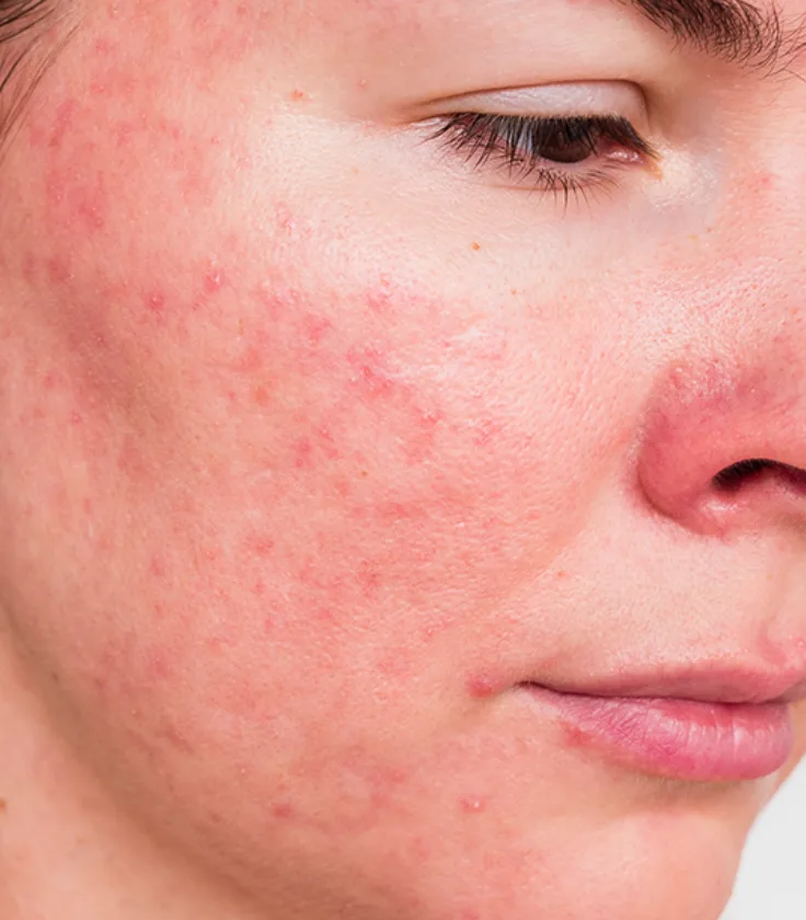 Rosacea Med Spa In Tulsa Ok Tulsa Hills Cosmetic And Laser Skin Center