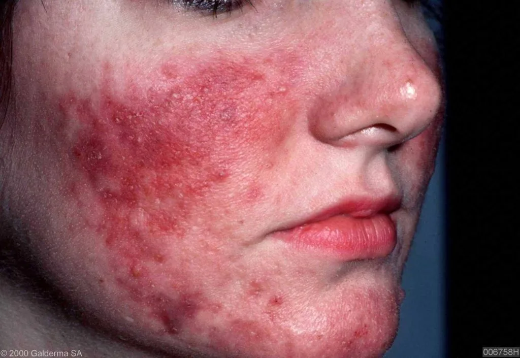 Rosacea Wat Te Doen Tegen Rosacea