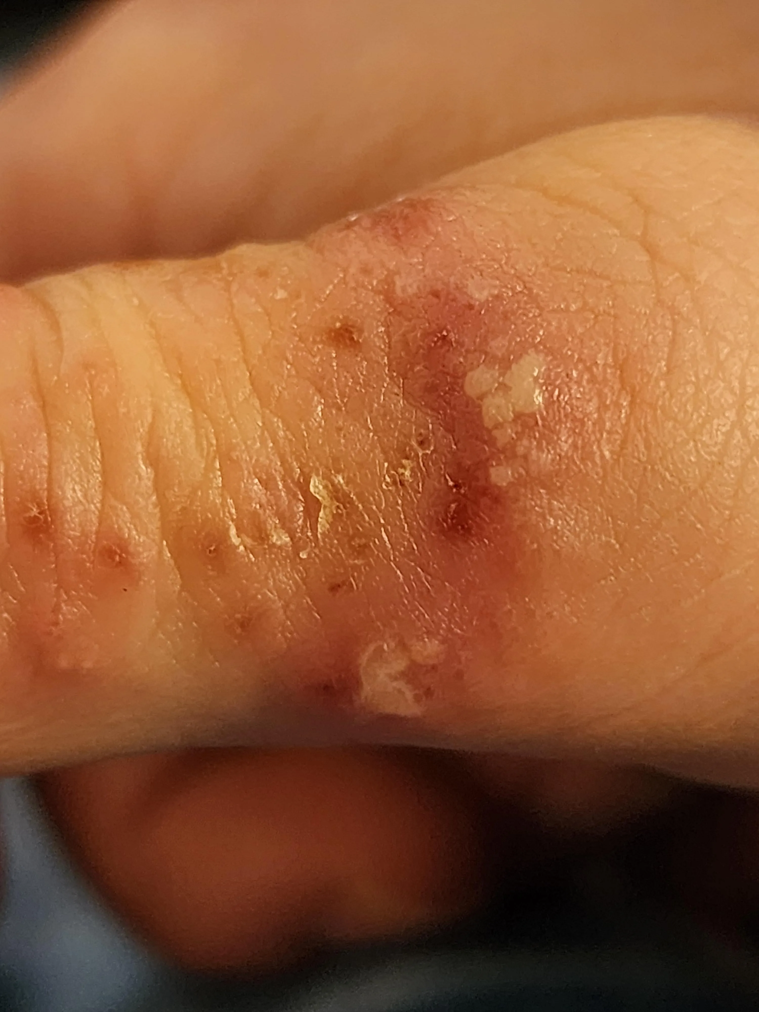 Scabies