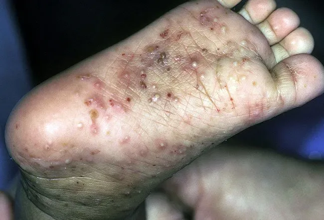 Scabies 3 Picture Image On