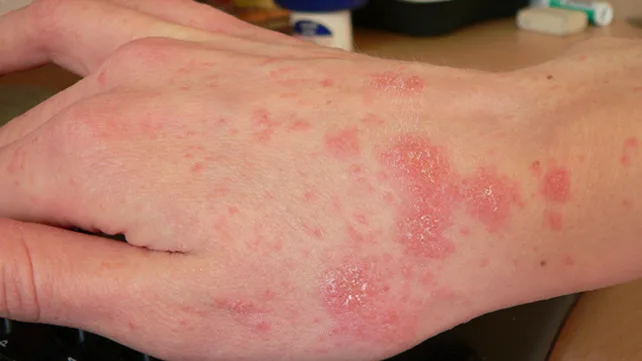 Scabies And Treatment For It