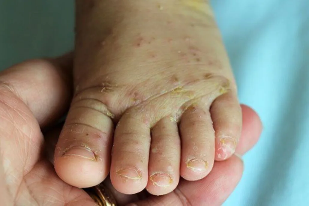 Scabies Healthtips By Teleme