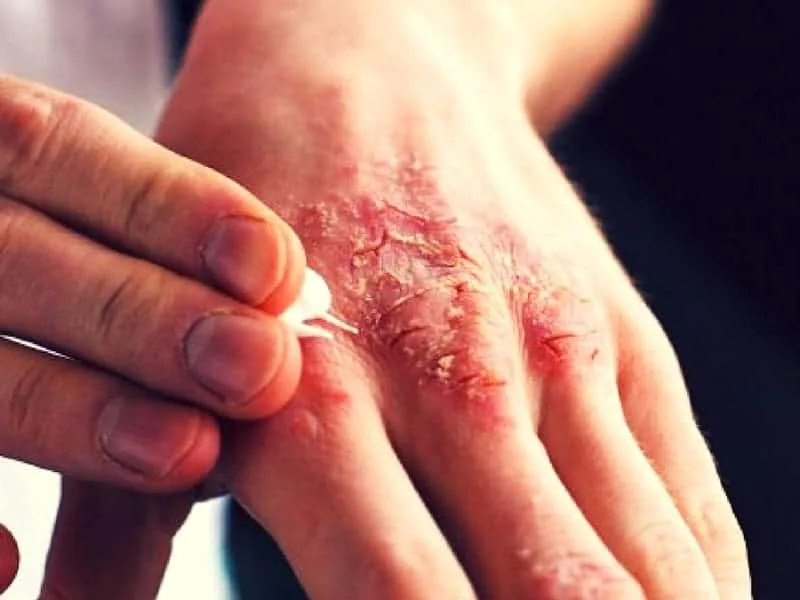 Scabies Symptoms And Treatment Healthy Life Insider
