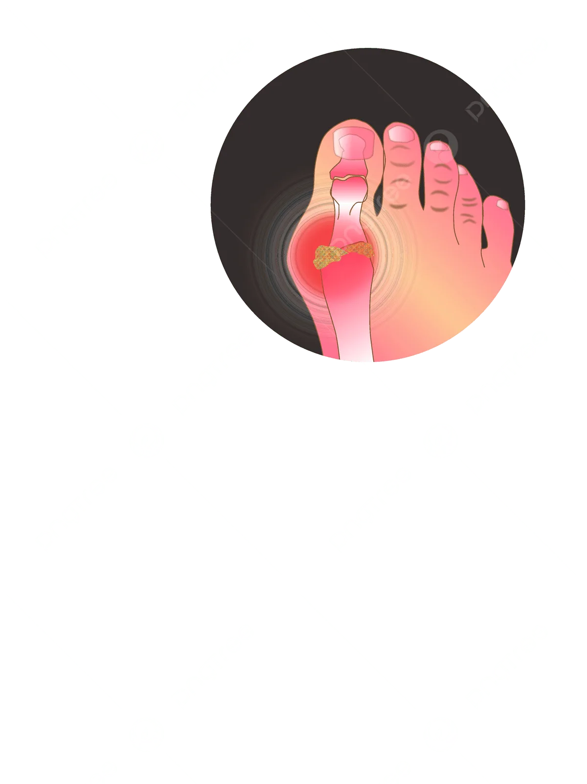 Schematic Diagram Of Gout Joint Gout Limb Human Body Png Tra