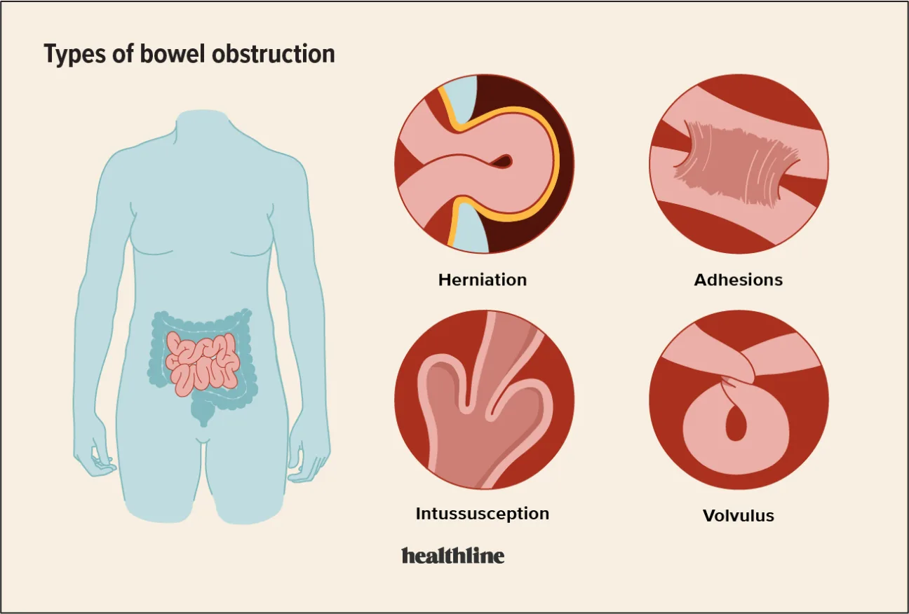 Schematic Diagram Of Pathophysiology Of Intestinal Obstructi