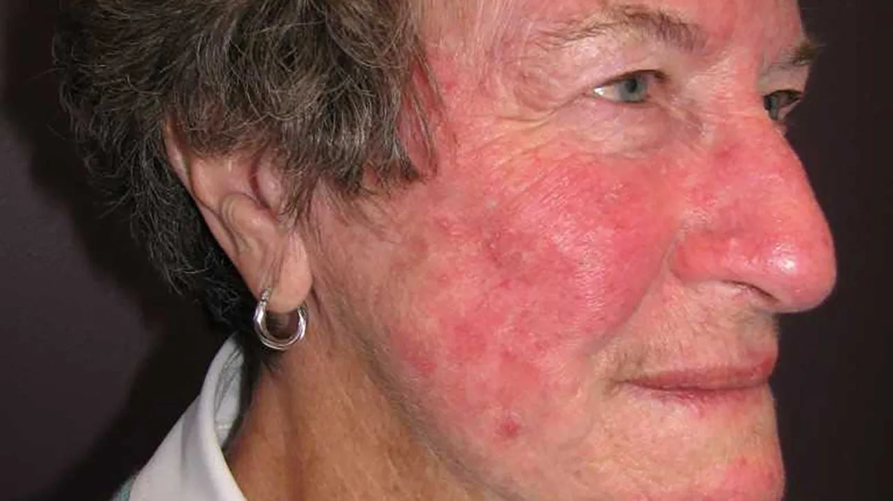 Severe Acne Rosacea