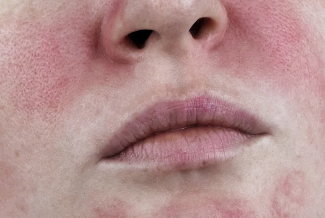 Skin Concerns Rosacea Redness Sensitivity Clinic
