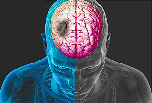 Stroke Rehab My Patient