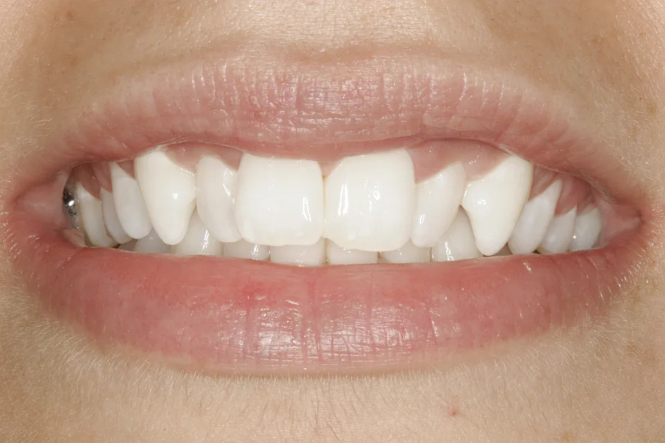Teeth1 The Center For Advanced Dentistry S Blog