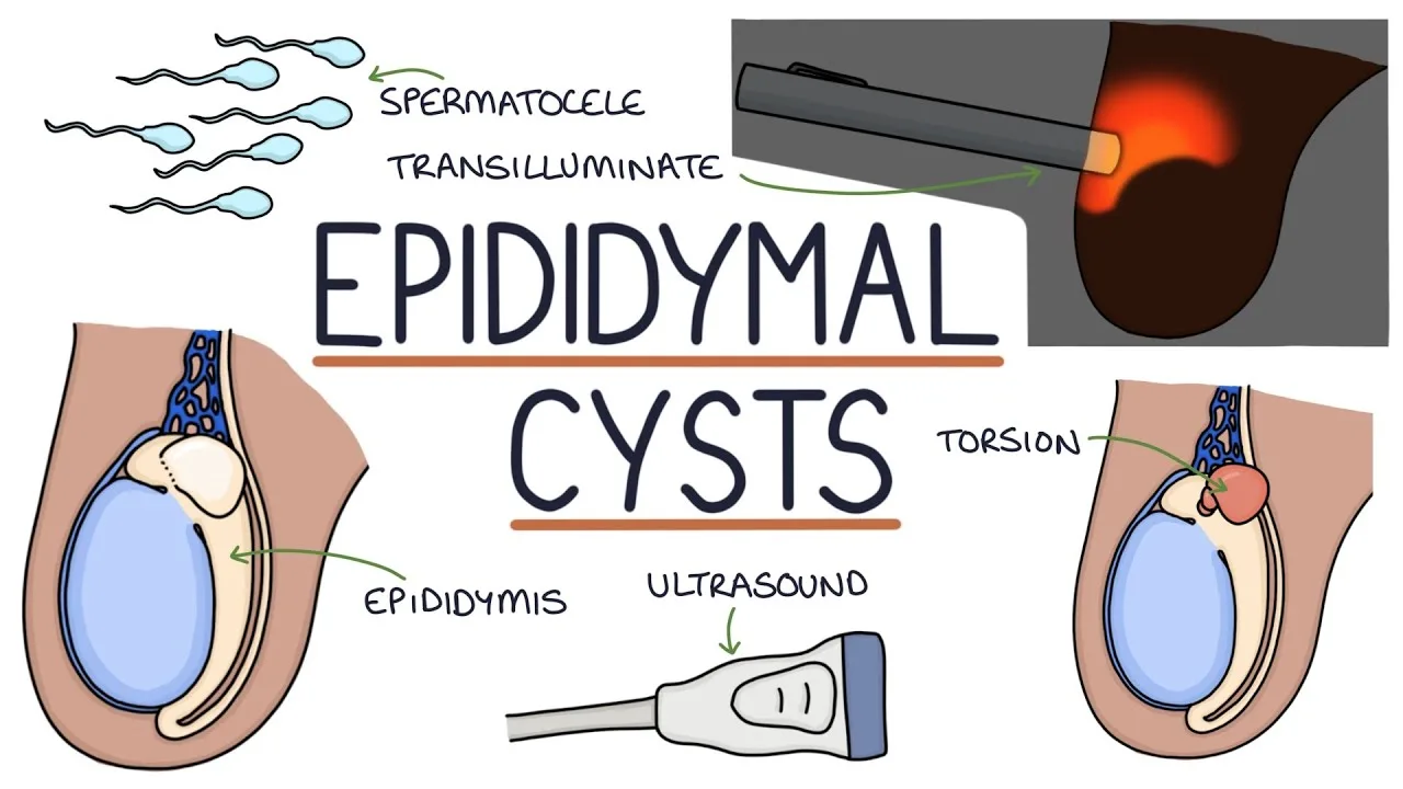 Testicular Cyst Ultrasound