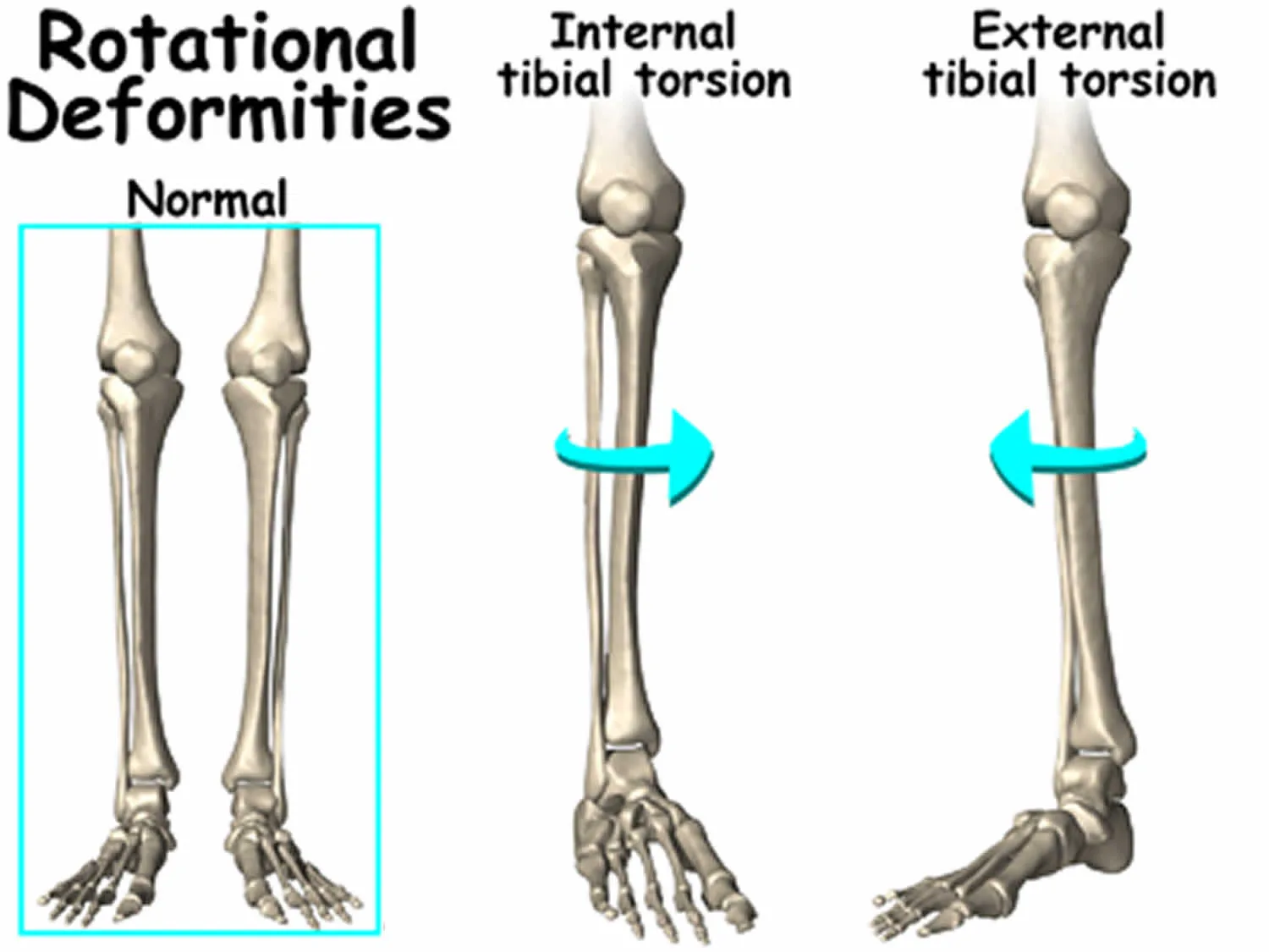 Tibial Torsion Causes Signs Symptoms Diagnosis Treatment Prognosis