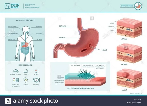 Ulcer Pain Location Diagram