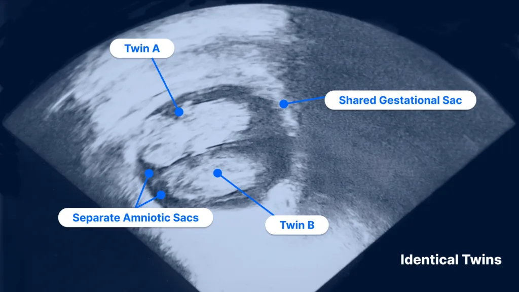 Ultrasound Pictures Of Identical Twins