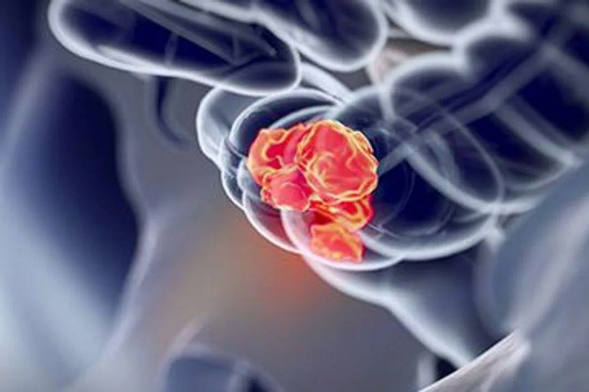 Variable Test Performance Seen With Fit For Advanced Colorectal Neoplasia
