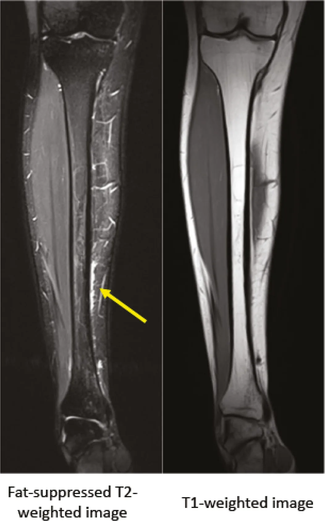 View Of Evaluation And Diagnosis Of Tibial Bone Stress Injuries In Adolescents Imaging And