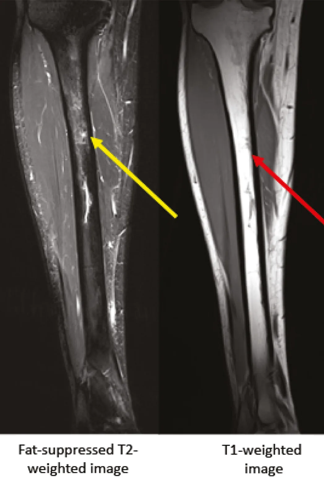 View Of Evaluation And Diagnosis Of Tibial Bone Stress Injuries In Adolescents Imaging And