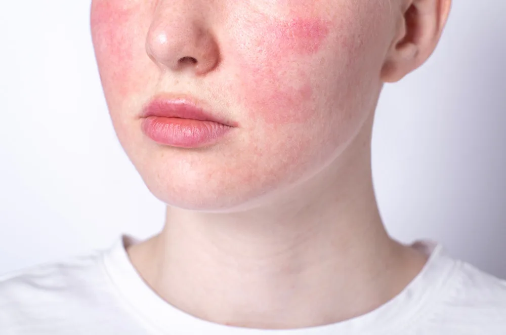 West Omaha Rosacea Treatment Dermatologist Skin Condition Therapy