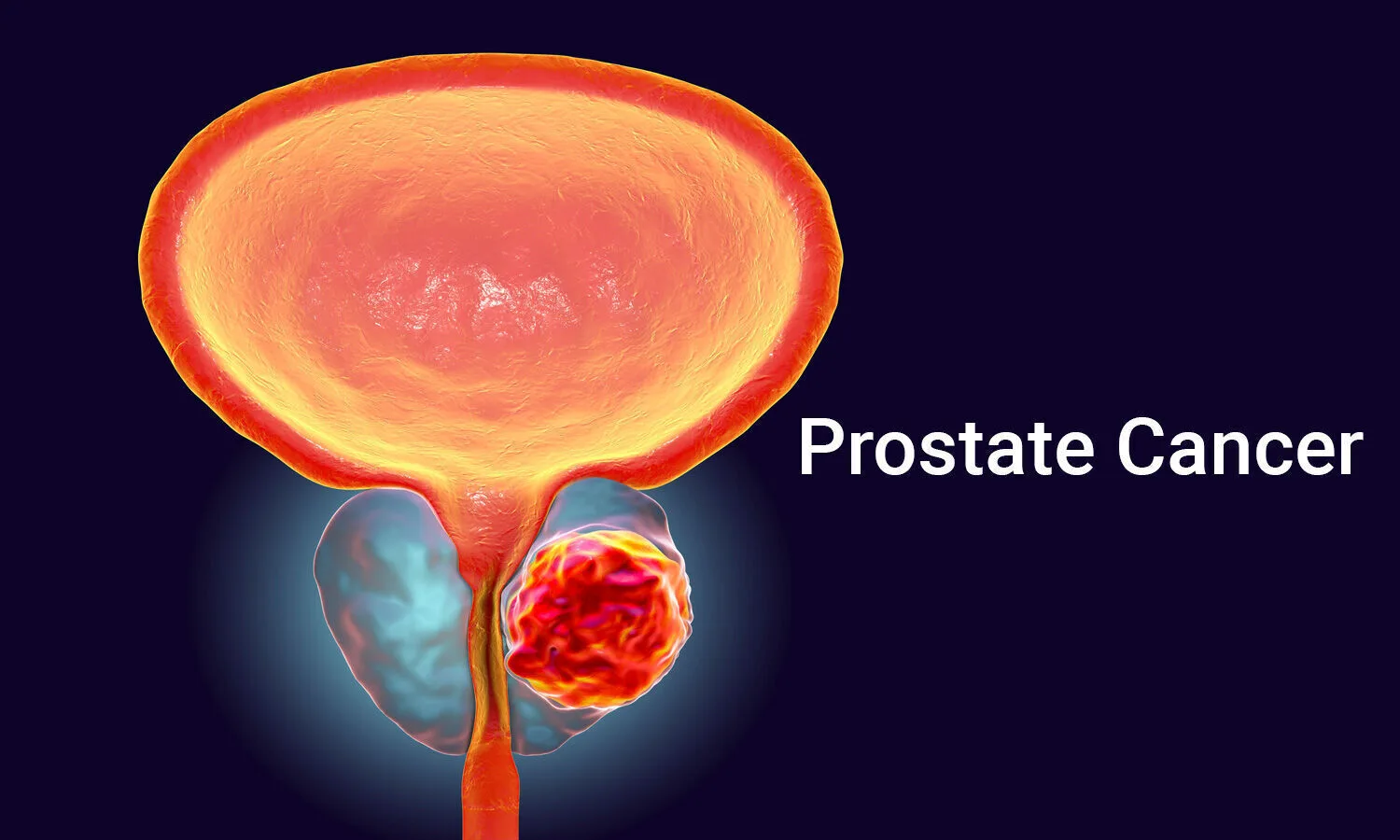 Zinc Supplement Use And Risk Of Prostate Cancer At Tammy Cornell Blog